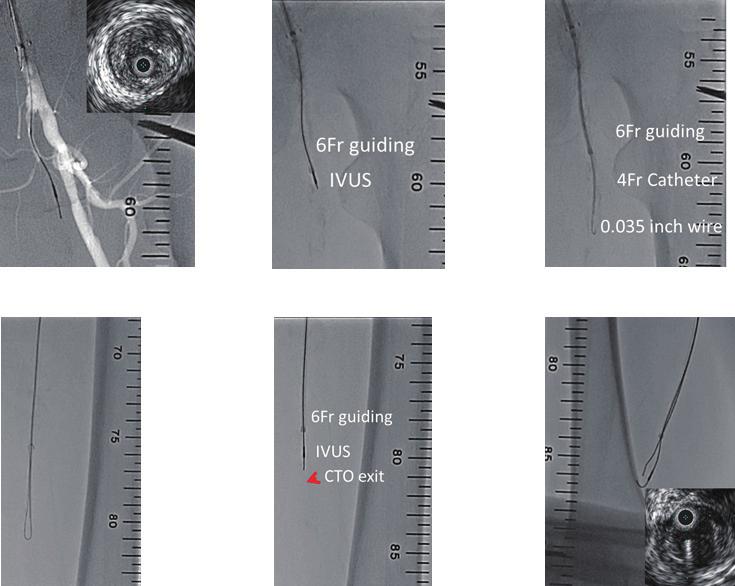 1073 A B C D E F Fig.2. Procedural steps for a combination of IVUS-guided wiring and looped wire technique. A 6-F straight guiding catheter is placed immediately before the CTO entrance stump.