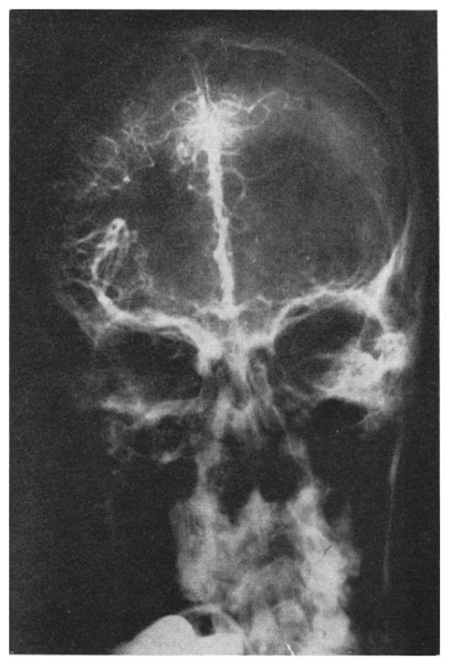 He had a right lower facial weakness. All other cranial nerves were intact.