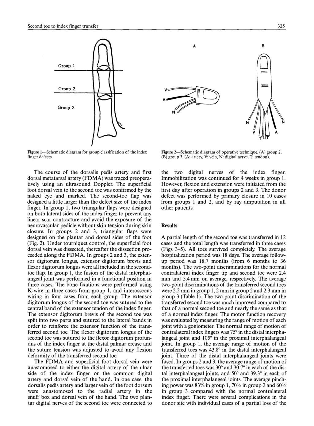 Second toe to index finger transfer 325 B Group 1 Group 2 Group 3 \ \ A Figure 1--Schematic diagram for group classification of the index finger defects.