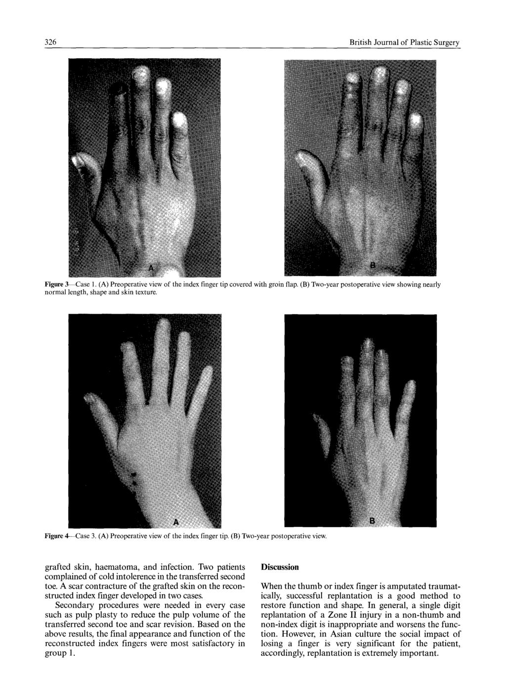 326 British Journal of Plastic Surgery Figure 3--Case 1. (A) Preoperativeviewof the index finger tip coveredwith groin flap.