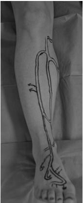 Anterior Tibial Artery Access The tibial vessels are accessed in the following fashion:.