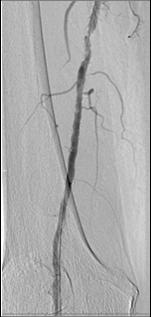 Unable to Maintain Lumen Post High-Pressure PTA Pre- Procedure Calcified Lesion Stent Malappostion