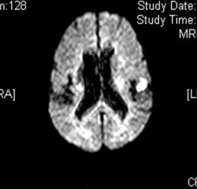 vessel changes. (Fig. 1) Subsequent magnetic resonance imaging (MRI) demonstrated acute left hemisphere stroke in the perisylvian area and old right subcortical infarct. (Fig. 2 and Fig.