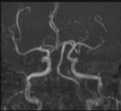 Figure 4 Figure 4: MRA at the level of circle of Willis showing irregularities in the distal M1 and lack of visualization of the posterior division of the left MCA On hospital day (HD) 3 patient was