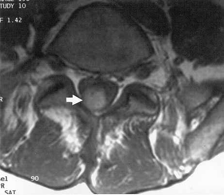 C, T1- and (D) T2-weighted axial magnetic resonance images. On all images white arrows demonstrate hematoma and black arrows the compressed nerve roots of cauda equina.