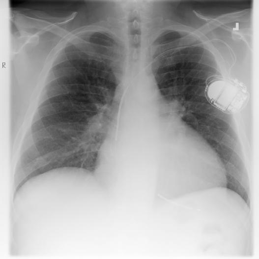 Chest X ray No temporal