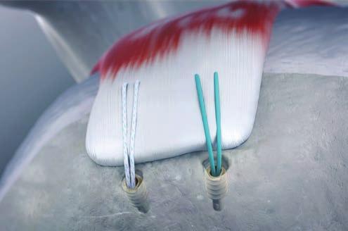 SPEEDSCREW system Fully threaded knotless implant system The SPEEDSCREW system is specifically designed for rotator cuff repair surgery.