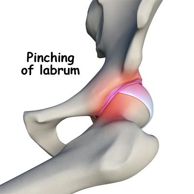 BIOMECHANICS OF THE ACETABULAR LABRUM Hip extension with combined ER or abduction force results in large strains in the anterior labrum (Crawford 2007) Hip motion is limited by tension in the capsule