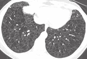 polyposis; and chorioretinal disease [12]. The limited information on HRCT findings in patients with irt-hogg- Dubé syndrome reveals bullous emphysema, thin-walled cysts (80%), and pneumothorax (Figs.