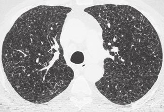 HRCT of Diffuse Cystic Lung Disease Fig.
