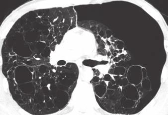 7 Langerhans cell histiocytosis in 50-year-old male smoker.