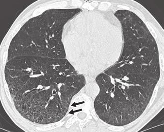 intervening normal lung parenchyma.