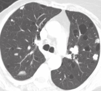 lymphocytic interstitial pneumonia, the latter of which generally has more widespread interstitial involvement.