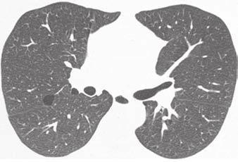 emphysema; thin-walled cysts, as shown on these high-resolution CT images; and