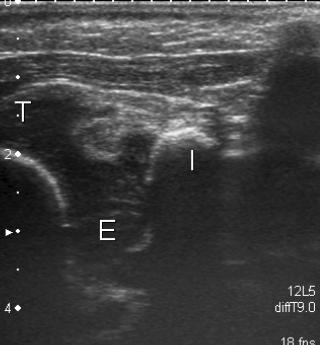 Transverse View: anatomy and ultrasound