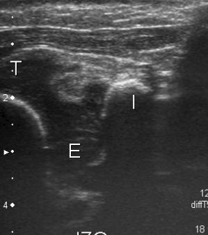 Transverse View: normal and pathologic ultrasound findings We must compare the healthy side (left) with pathological one (right), moving