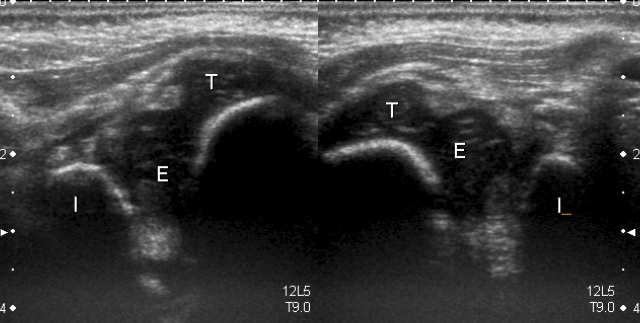 Transverse View: Bilateral pathologic ultrasound findings RIGHT LEFT In cases of bilateral DDH, the comparison is even more necessary, because sometimes one hip is reduced