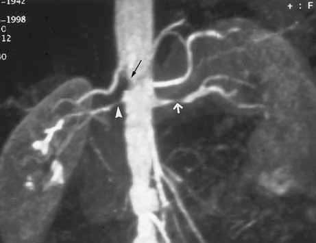 lesion does not cause stenosis. The lower right renal artery has a proximal stenosis (arrowhead). A stenosis of the left renal artery is also demonstrated (white arrow).