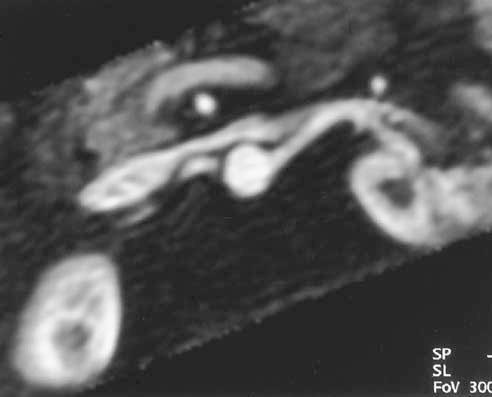 A large renal cyst is also seen.