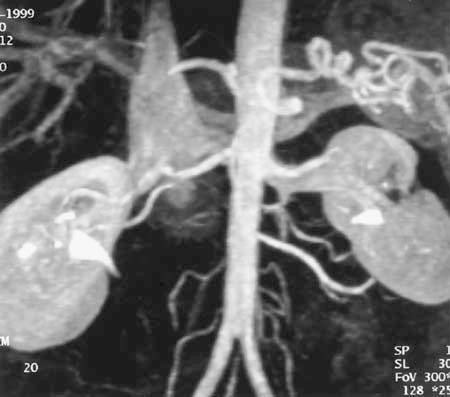 artery (c) and a 90% stenosis of the left renal artery (d). Figure 13.