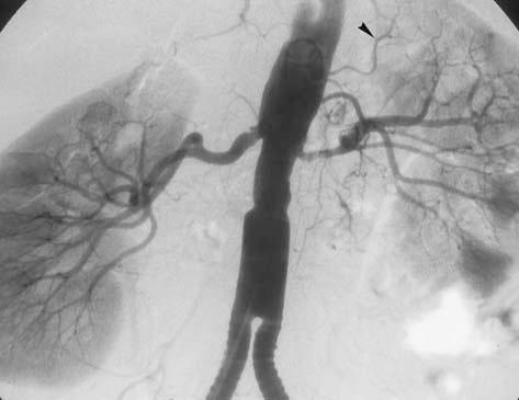 Relative to conventional angiography, there is a tendency with MR angiography to overestimate moderate stenosis (Fig 14).