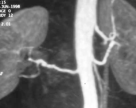RG Volume 20 Number 5 Soulez et al 1367 c. d. Figure 15. Accessory artery in a 35-year-old patient with severe hypertension.