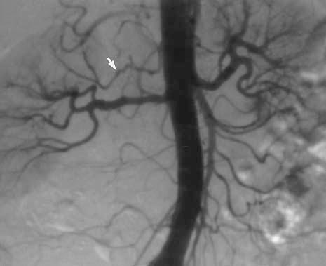 (b) Conventional aortogram shows fibromuscular dysplasia involving both renal arteries. A possible accessory artery is seen on the right side (arrow).