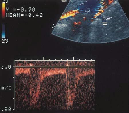 Two approaches are used to detect RAS with Doppler US: direct visualization of the renal arteries and analysis of intrarenal Doppler waveforms. a. b. Figure 6.