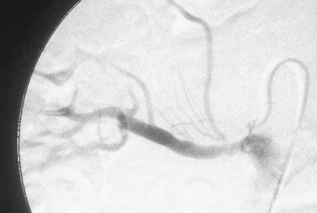 (d) Abdominal aortogram shows severe stenosis of the left renal artery (arrow).