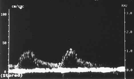 (a) Intrarenal Doppler spectrum from the left kidney shows a waveform with a straight systolic upstroke (arrows).