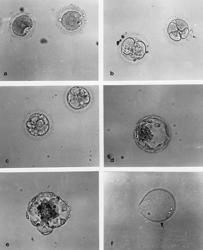 Hydrosalpinx fluid and human embryos Figure 1. Early human embryogenesis in medium containing hydrosalpinx fluid (50%). (a) 3PN fertilized eggs. (b) 2- and 4-cell -embryos. (c) 6- to 8-cell embryos.