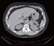 Figure 1 Computerized tomography scan of the abdomen demonstrating left adrenal nodule 3.5 cm. depending on the presence of cystic-necrotic areas, which do not enhance [88].