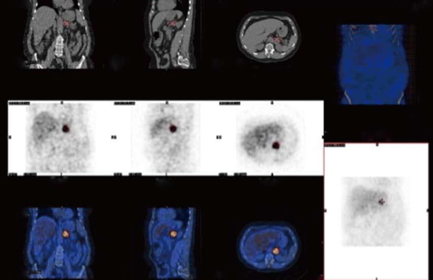 Functional imaging examinations are performed using 131 I- and 123 I-metaiodobenzylguanidine (MIBG) (Figure 2), 111 In-pentetreotide (Octreoscan, Covidien), and several PET ligands including 18