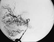 Šeruga T / Endovascular treatment of intracranial arteriovenous malformations 205 Endovascular embolization was performed with the aim to reduce the volume of the AVM, to enable subsequent