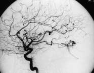 DSA angiography in left lateral projection showed small cortical temporoparietal AVM with a single feeding artery arising from the left middle cerebral artery with superficial venous drainage to the