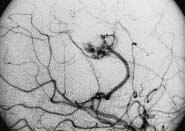206 Šeruga T / Endovascular treatment of intracranial arteriovenous malformations endovascular treatment. Feeding arteries were branches of the right middle cerebral artery.