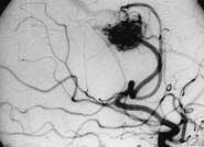 It was not suitable for embolization. The other feeding artery was successfully embossed. The rest of AVM was later resected by microsurgical operation (Figures 5,