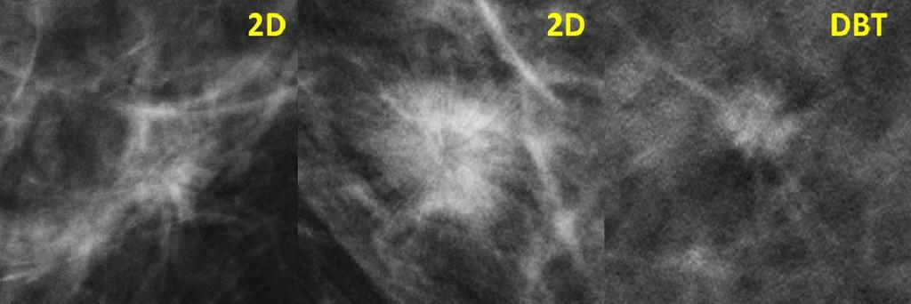 The Hologic system while operating in combo mode produces a 2D image with a pixel pitch of 70um and 15 tomosynthesis projections with a pixel pitch of 140um acquired over the angular range +7.