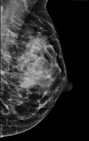 Increased vascularity and prominent ductal system is also seen 6 Pitfalls: Carcinoma may be obscured on mammogram due to diffuse increase in density.