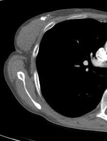 Nearly all calcifications seen on CT are benign, on the basis of size alone Lucent-centered calcifications, eggshell or rim calcifications, coarse or