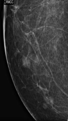 ductal cancer at mammography Secondary (manifestation of lymphoma