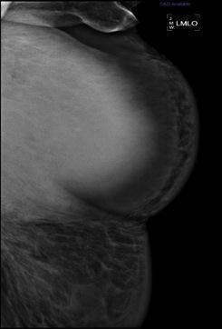 seen Breast mass, asymmetric focal density, breast