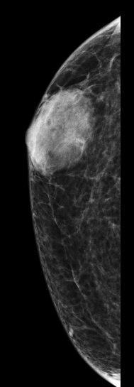 with lobulation or even spiculation 1 Pitfalls: Mimics breast cancer on ultrasound.