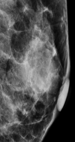 patient is symptomatic Simple Cyst Common breast mass