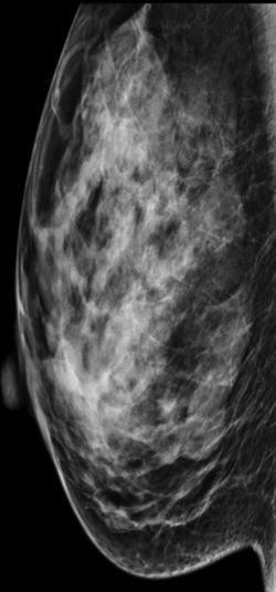 in some cases Fibroadenoma Most common benign solid breast tumor that