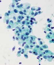 Histiocytoid cells in PTC An