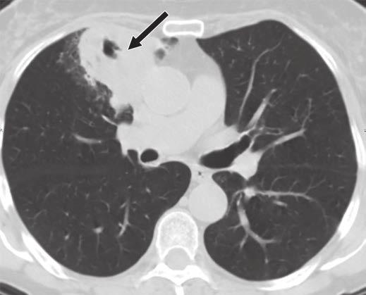 Lung Cancers Manifesting as Part-Solid Nodules Fig.