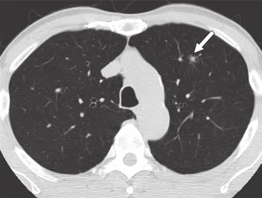 If the lung parenchyma within the entire nodule was obscured, it was classified as a solid nodule (Fig. 2).