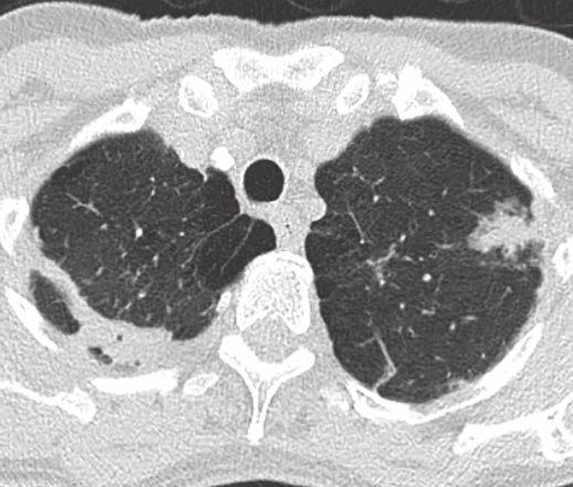 7 mm (SD, 14.4) when first seen and was 24.1 mm (SD, 13.8) on the last CT study before diagnosis.