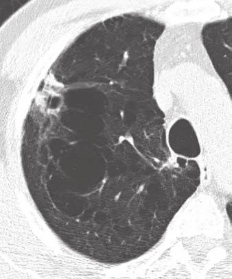 Lung Cancers Manifesting as Part-Solid Nodules results of Noguchi et al.